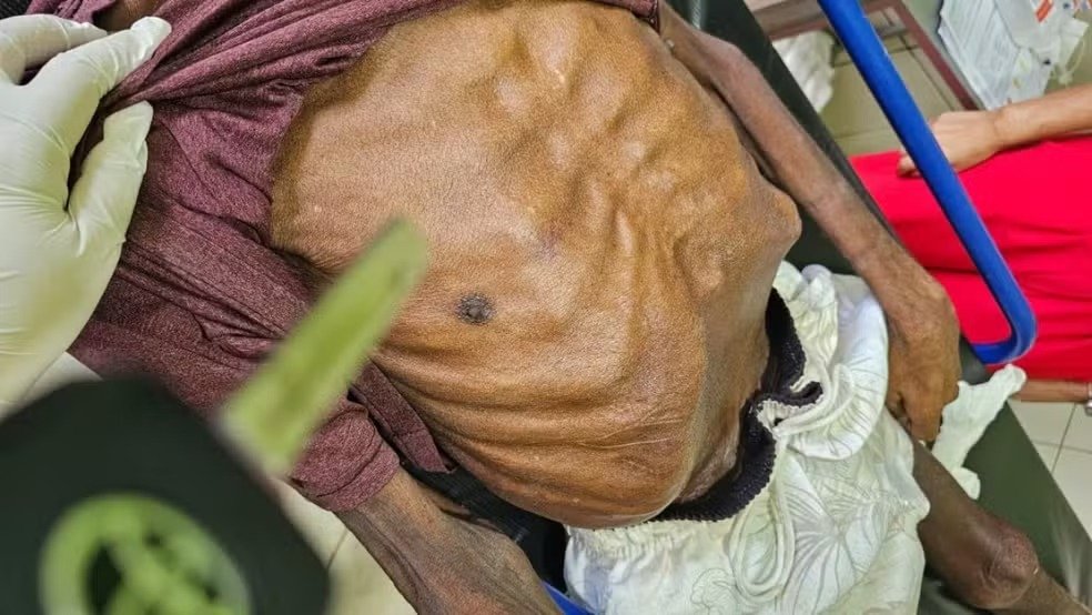 Filha é presa após idoso morrer desnutrido e com hematomas pelo corpo no Pará